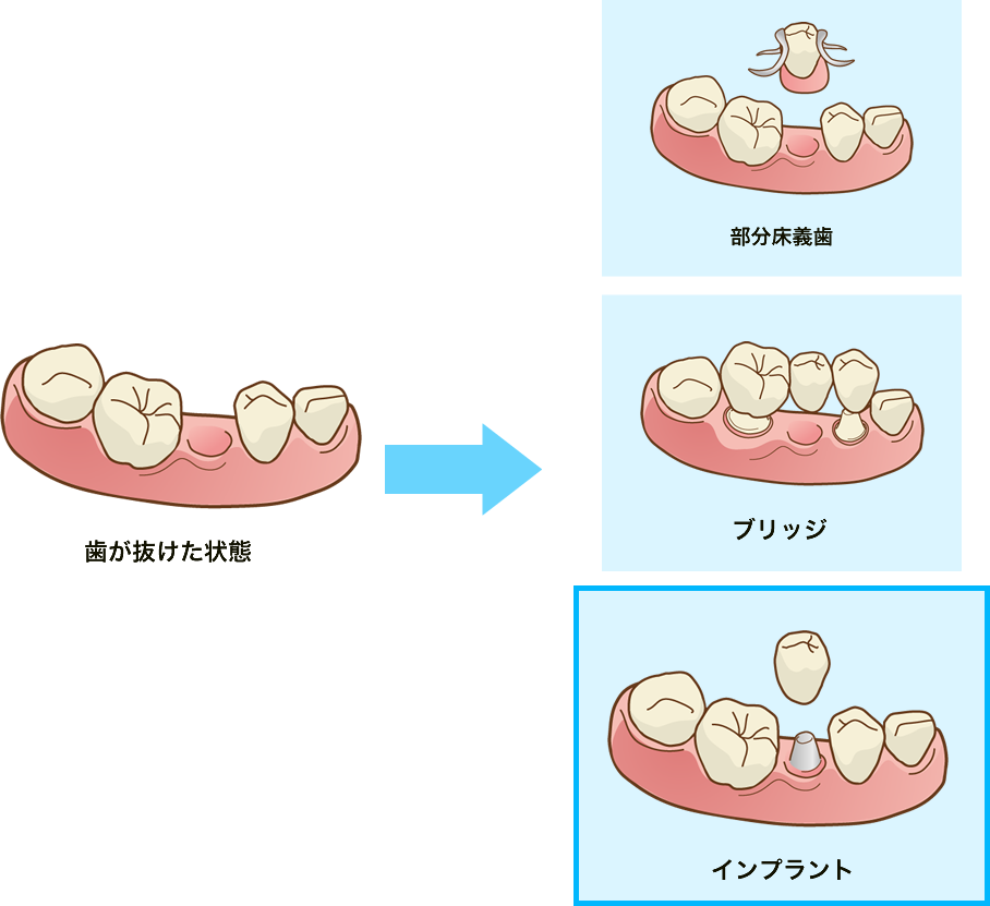 インプラントと義歯（入れ歯）、ブリッジの違い